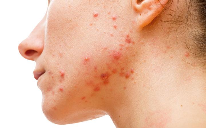 The First Footstep In Acne Skin Care & You Can Achieve Acne Control By Cleansing Your Skin