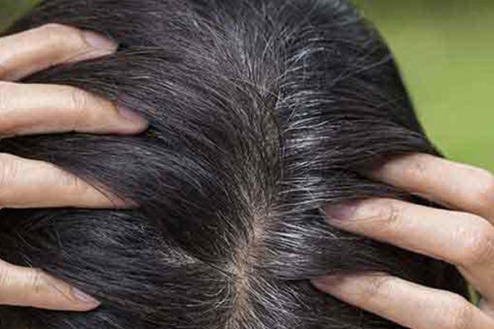 Prevent White Hair, Causes And Treatment