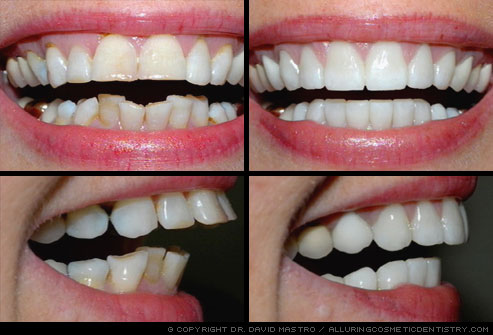 Best way to protect your teeth, protection for you and your kids.
