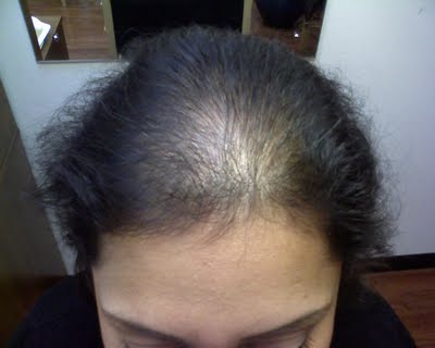 Useful info about hair loss in women.