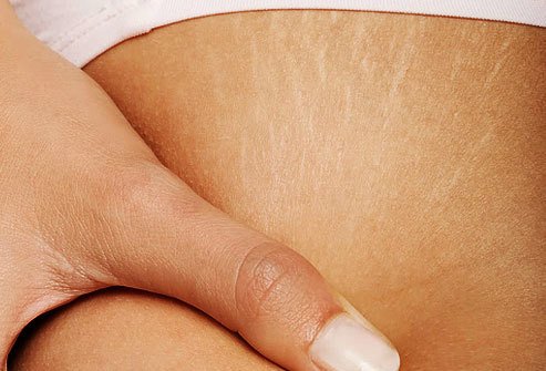 Signs of Collagen Deficiency