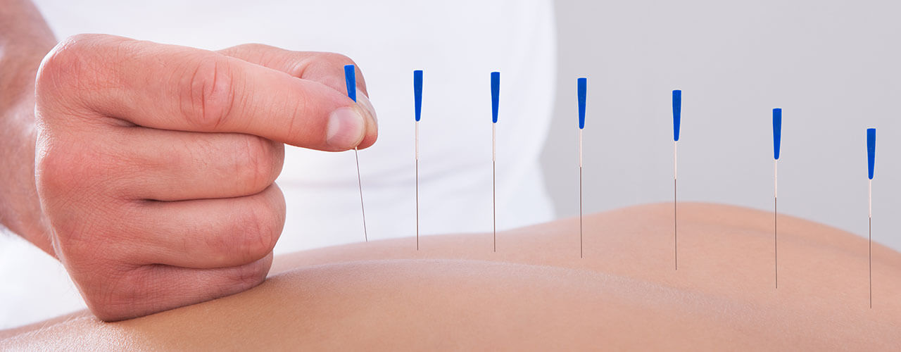 How Long Does It Take for Dry Needling to Work?