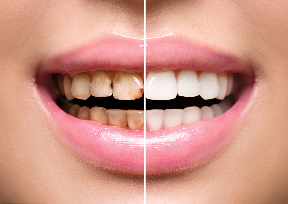 Make your smile bright with Tooth Whitening