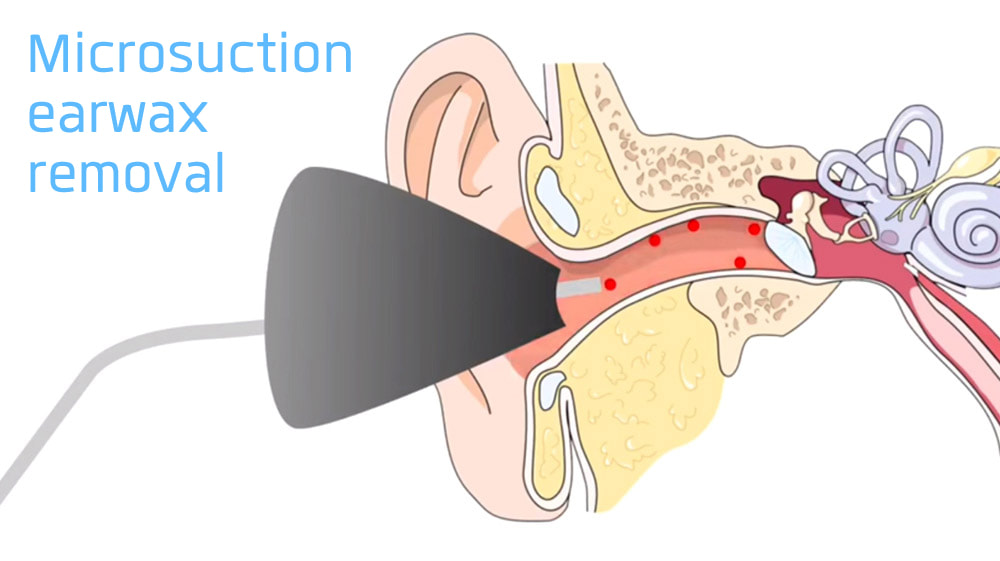 How people are now getting their ears cleaned in their lunch break